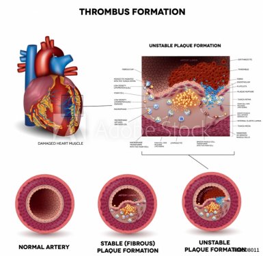 Blood clot formation. Anatomy of Healthy artery, unhealthy arter - 901145882