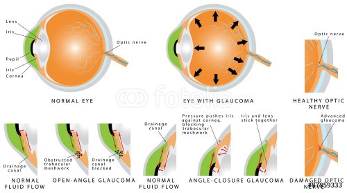 Glaucoma is an eye disease