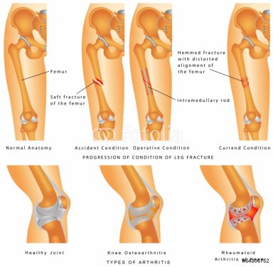 Hemmed fracture with distorted alignment of the femur - 901145836