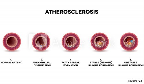 Atherosclerosis formation. Healthy artery and unhealthy arteries
