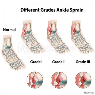 Grades of ankle sprains