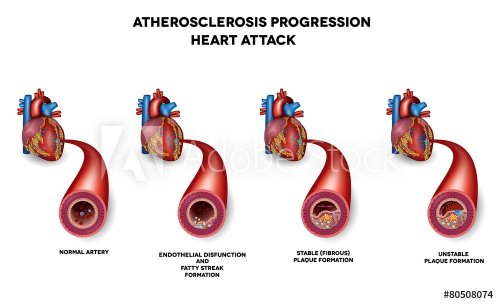 Heart attack, Coronary artery disease. Heart muscle damage