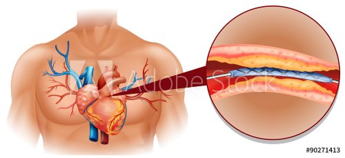 Human heart diagram with balloon tube