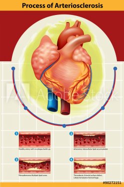 Poster of Arteriosclerosis process - 901145730