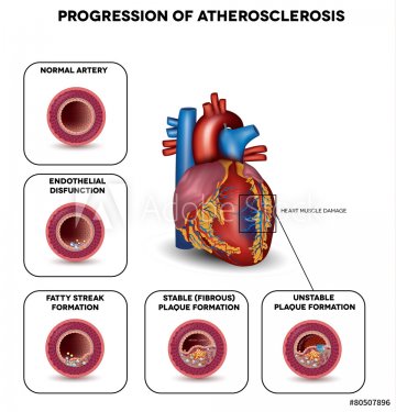 Progression of Atherosclerosis till heart attack. Heart muscle d