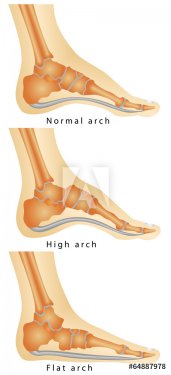 Set of flat foot, high arch.Rheumatoid Arthritis In Arch Of Foot