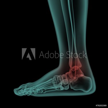 side x-ray view of human painful foot and ankle - 901145874